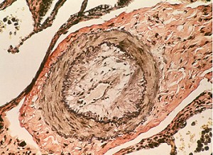 arteria enferma gruesa  hipertension pulmonar