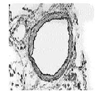 Arteria Normal Hipertension Pulmonar